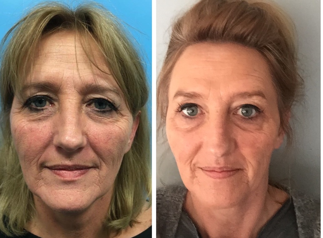 Botox Voor En Na Mislukt