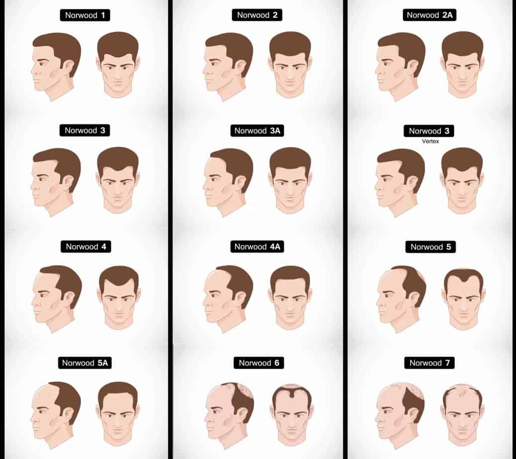 Hoeveel Haren Verlies Je Per Dag Man