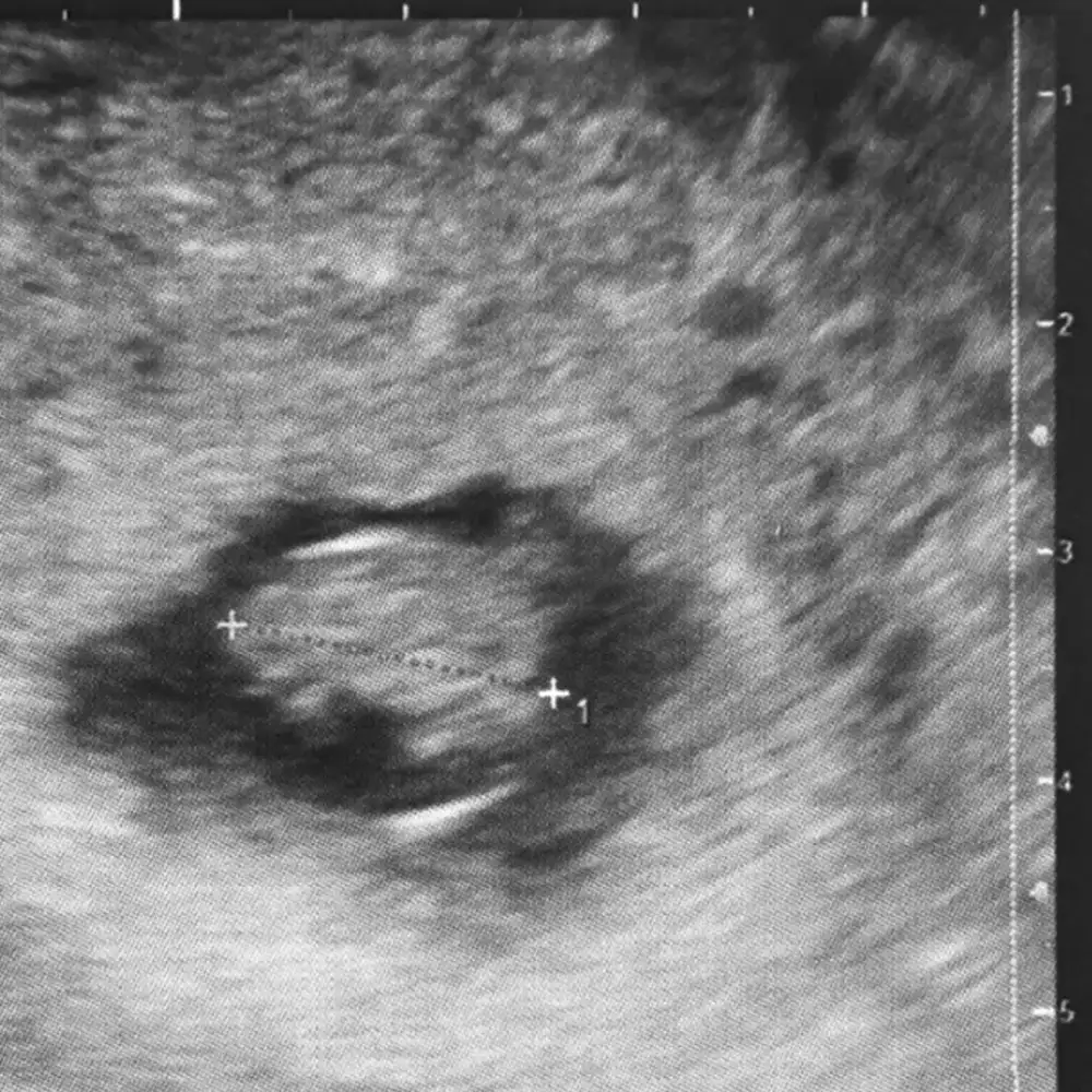 Kans Op Miskraam Na Kloppend Hartje 7 Weken