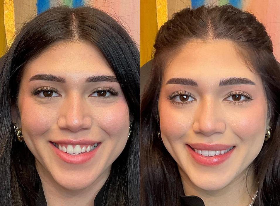 Lip Flip Voor En Na Before And After