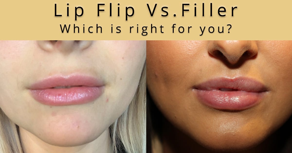 Lip Flip Vs Filler