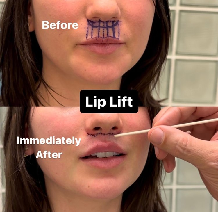 Lip Lift