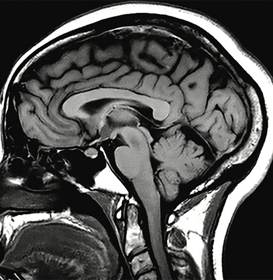 Does A Brain MRI Include The Neck