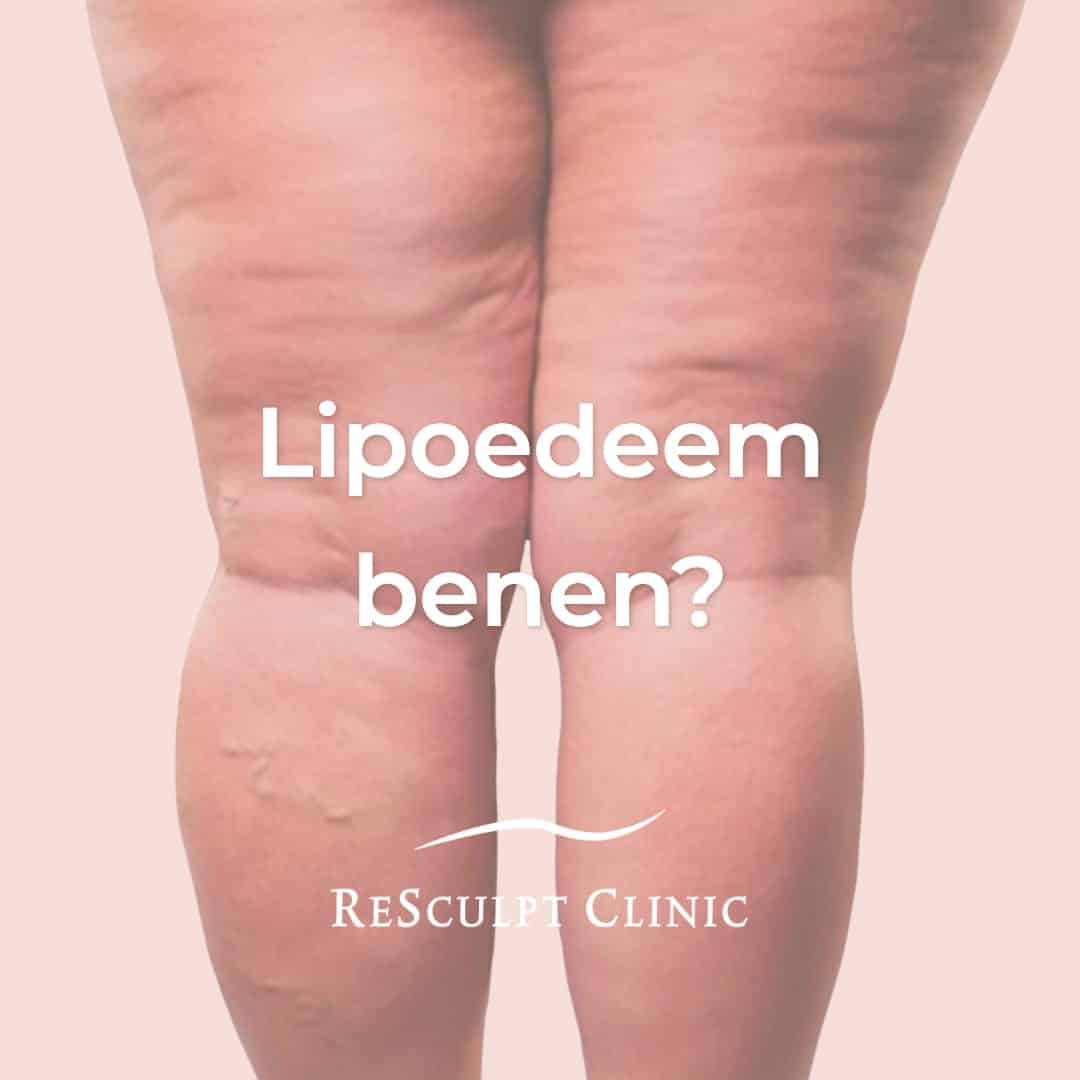 Hoe Vocht Uit Benen Krijgen