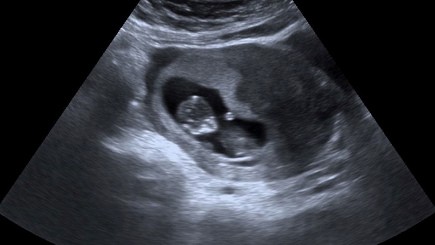 10 Weeks Pregnant Ultrasound