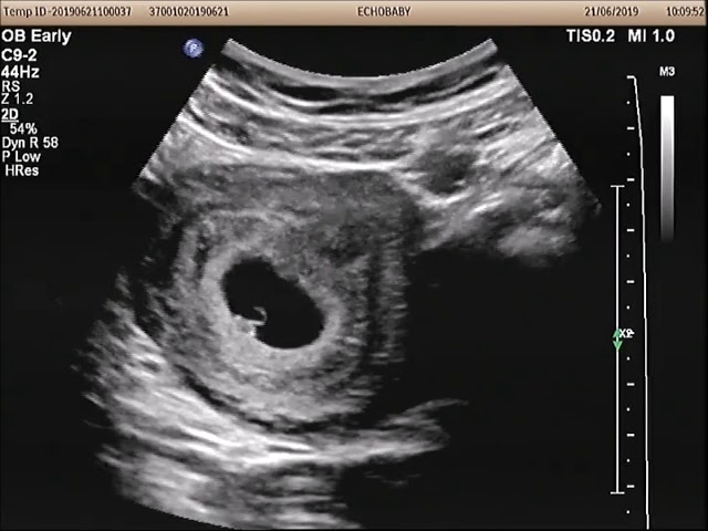 6 Weken Zwanger Echo