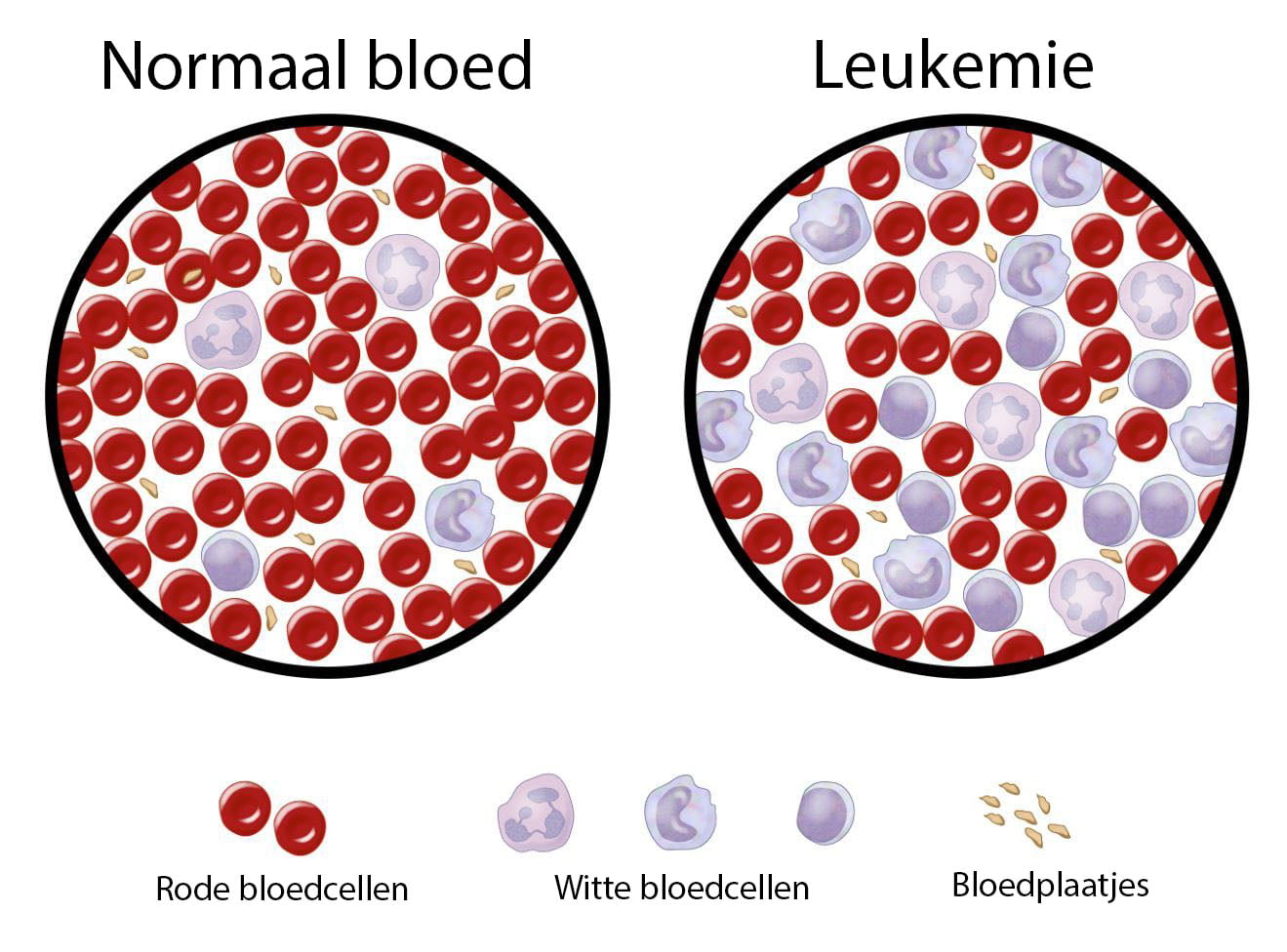 Acute Leukemie Oorzaak