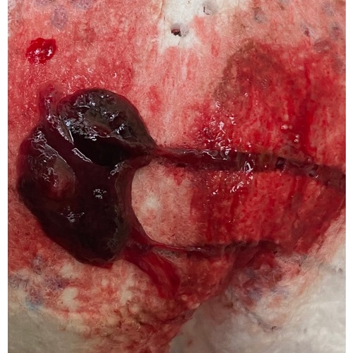 Hoe Ziet Een Miskraam Eruit 1 Week