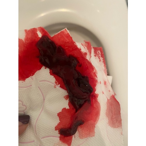 Hoe Ziet Een Miskraam Eruit 8 Weken