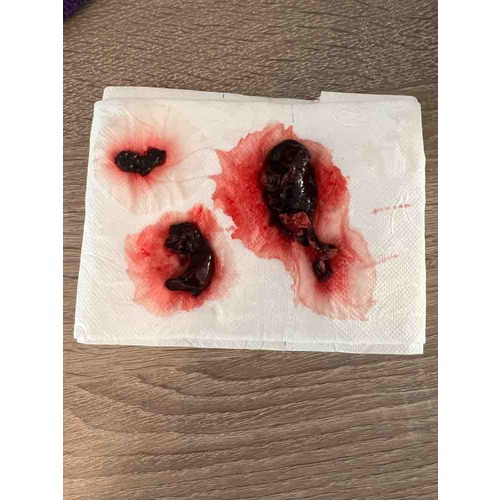 Hoe Ziet Een Vruchtzakje Eruit Bij Een Miskraam