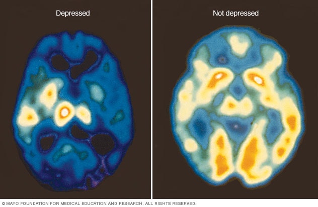 How Much Is A Brain Scan For Depression