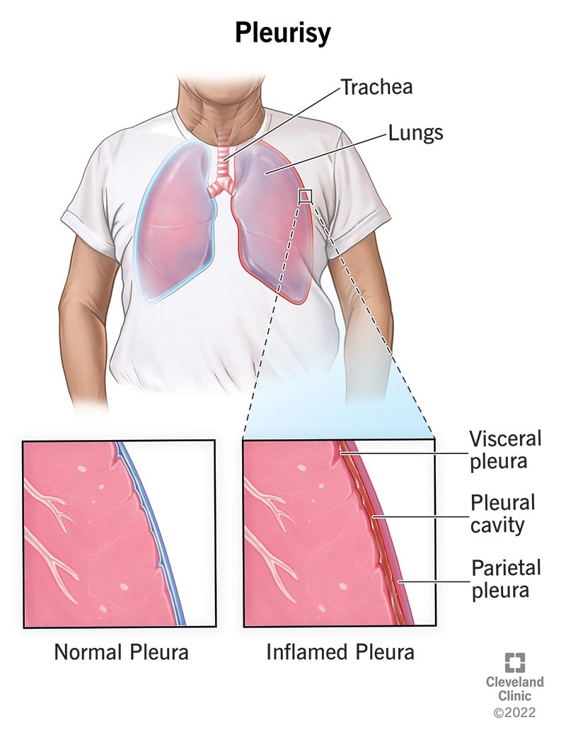 Is Pleurisy Dangerous