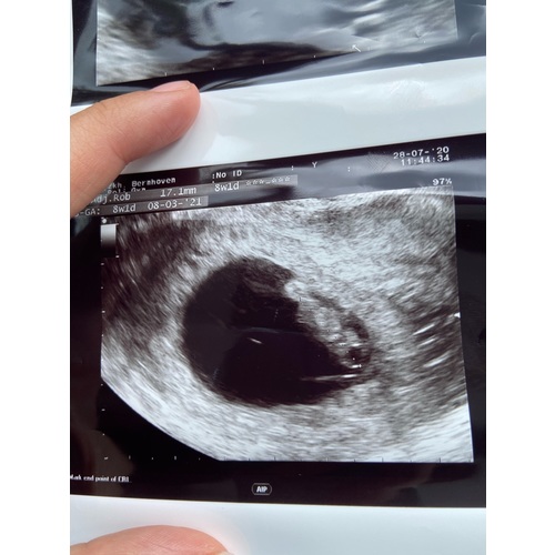 Kans Miskraam 8 Weken Kloppend Hartje