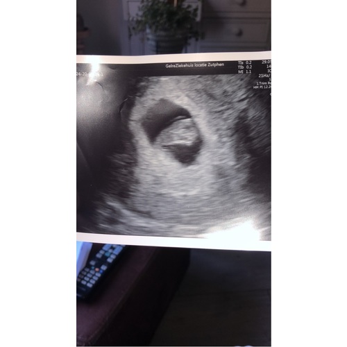 Kans Op Miskraam Na Kloppend Hartje