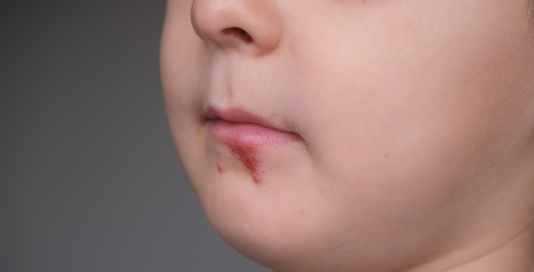 Koortslip Besmettelijk Baby