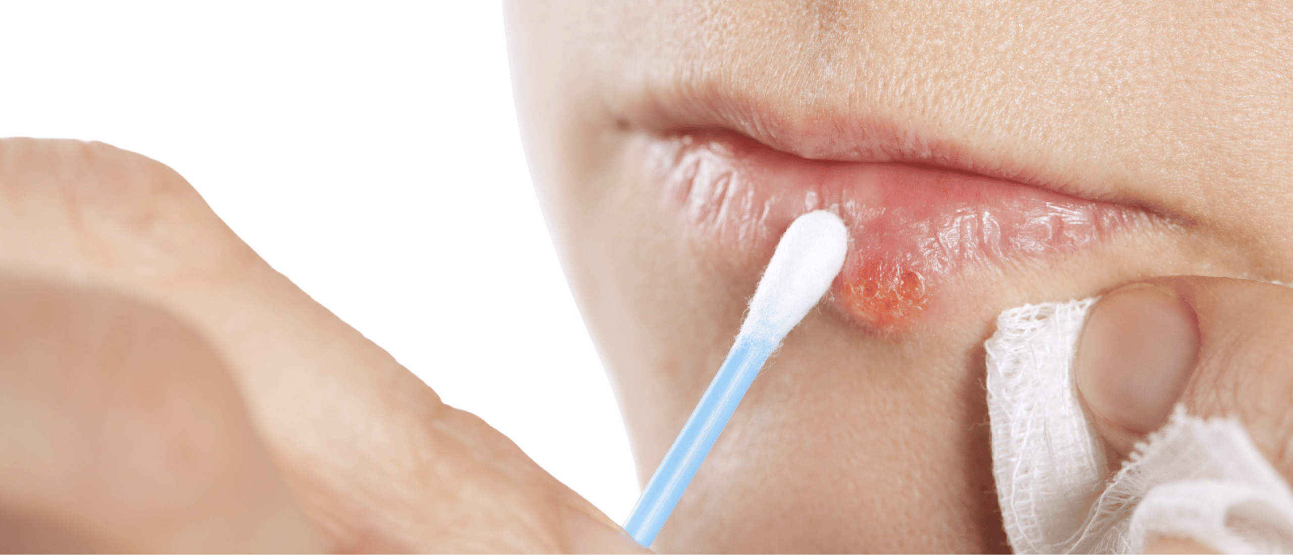 Koortslip Genezen Versnellen