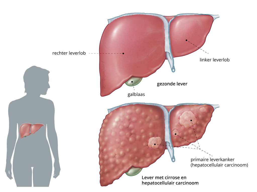 Leverkanker Symptomen