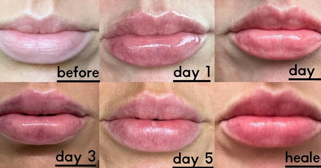 Lip Flip Results Day By Day