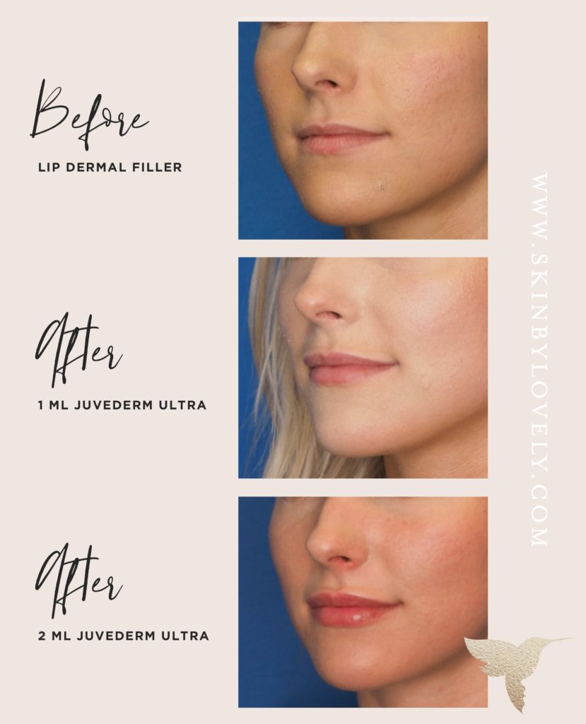 Lip Flip Vs Filler Vs Juvederm