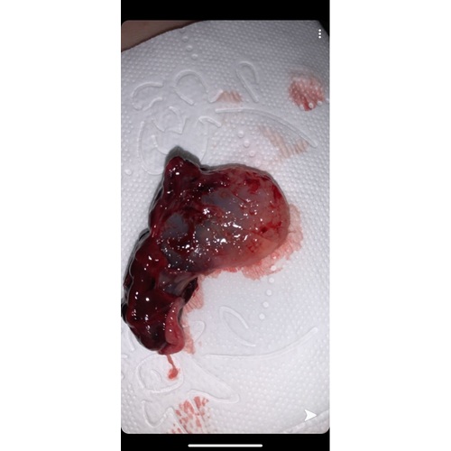 Miskraam 6 Weken Ervaring