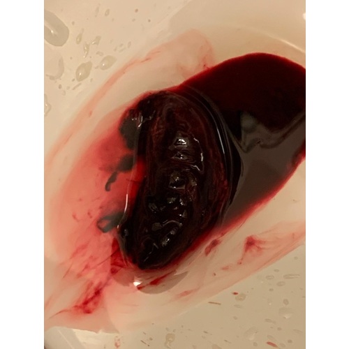 Miskraam Symptomen 5 Weken