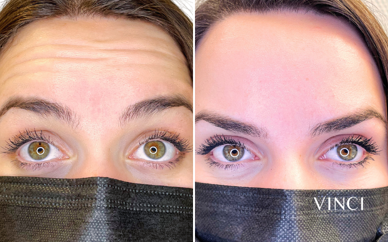 Raar Gevoel Na Botox