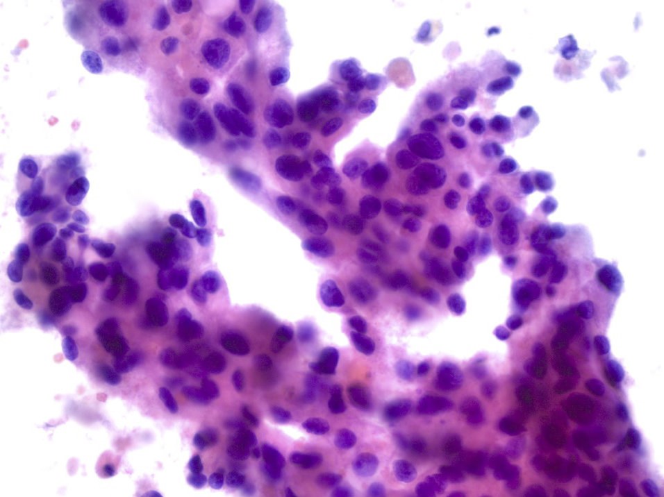 Salivary Duct Carcinoma Cytology