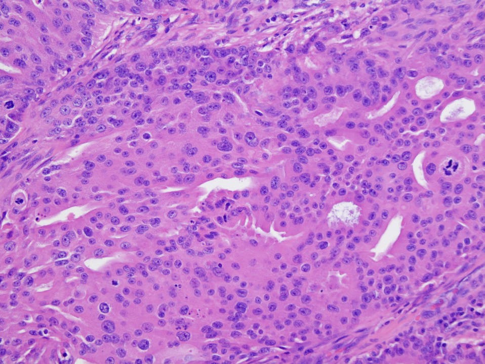 Salivary Duct Carcinoma Pathology Outlines