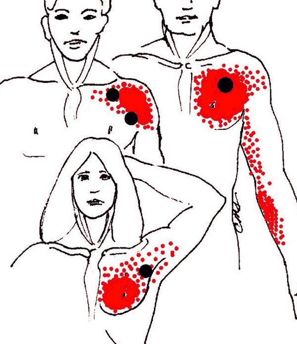 Stekende Pijn Boven Linker Borst