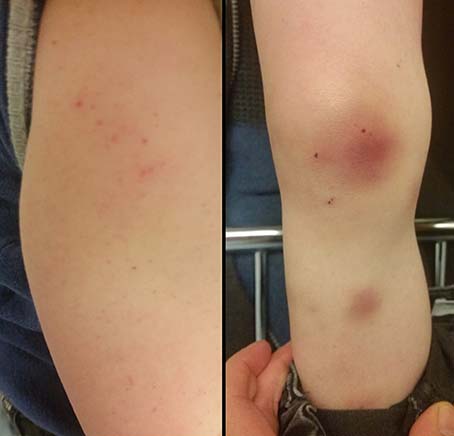 Symptomen Leukemie Kind 1 Jaar