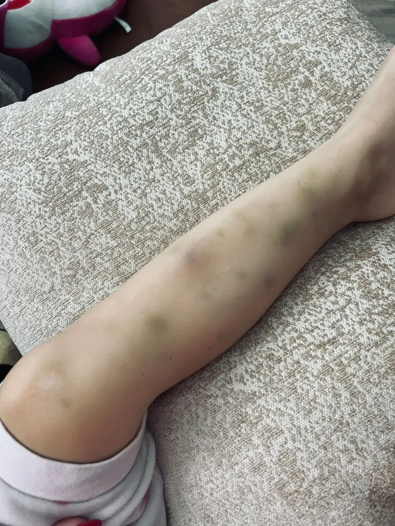 Symptomen Leukemie Kind