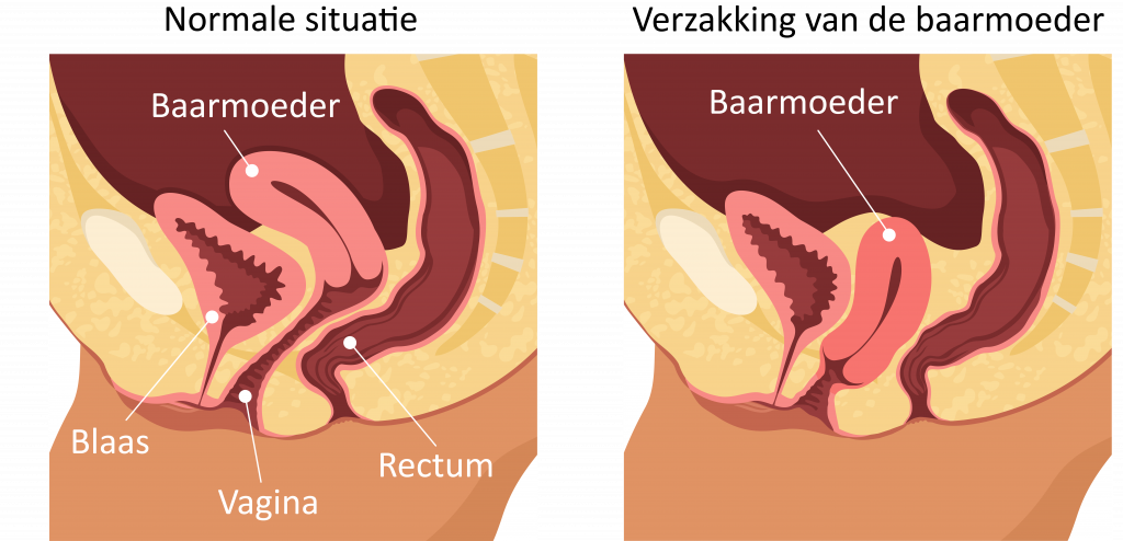 Verzakking Baarmoeder Operatie