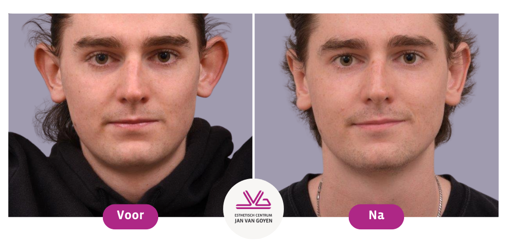 Voor En Na