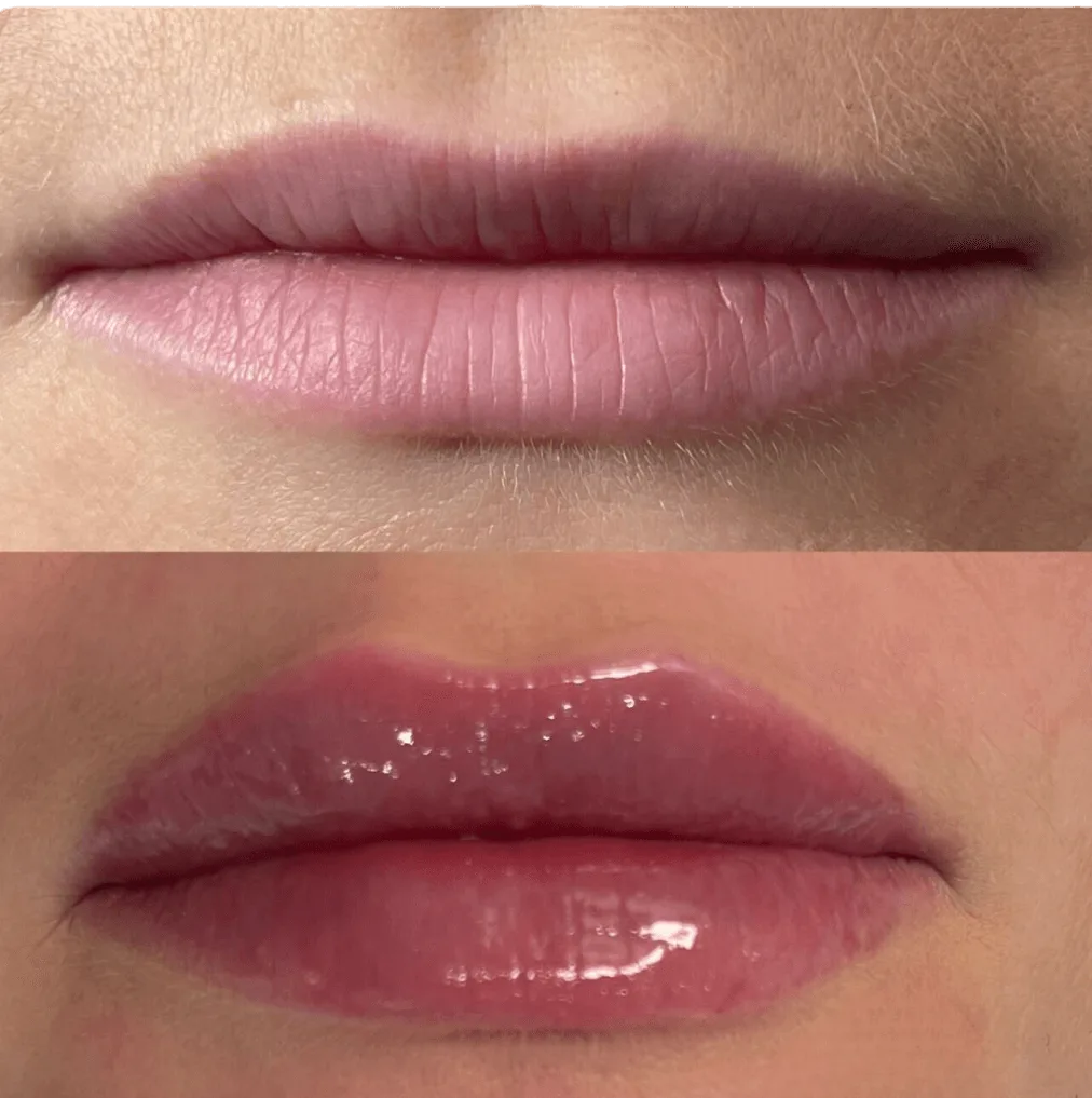 What Is A Lip Flip Gone Wrong Pictures
