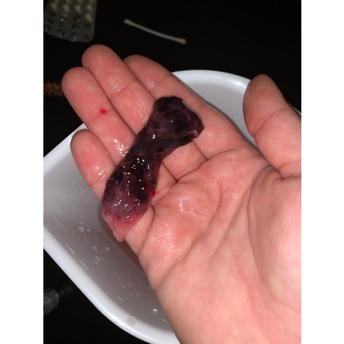 5 Weken Zwanger Kans Op Miskraam