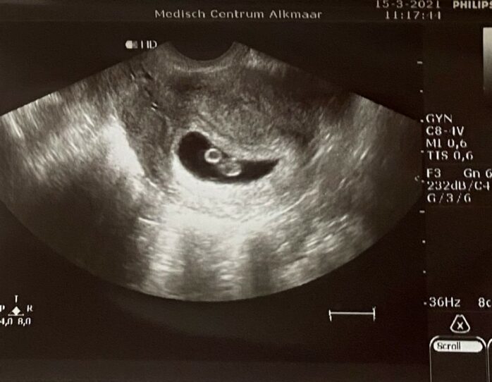 7 Weken Zwanger Echo