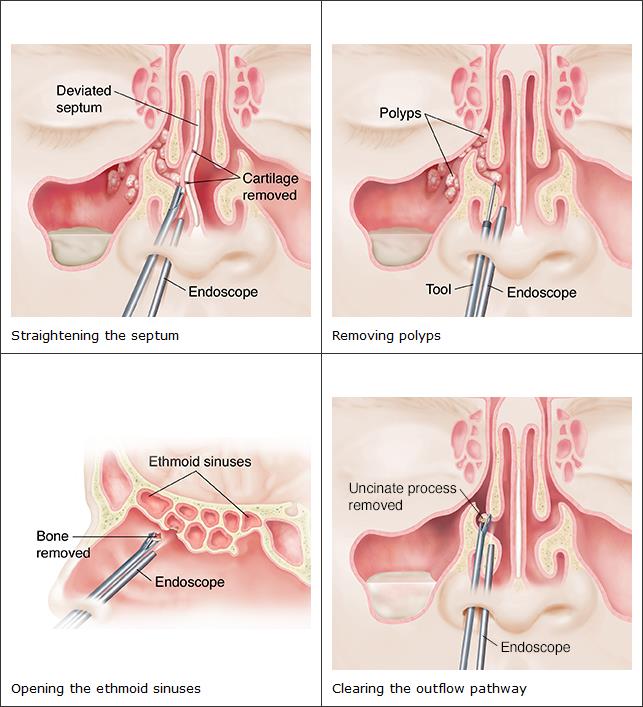 Chronisch Verstopte Neus Operatie