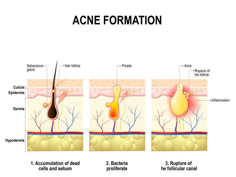 Overbelaste Lever Symptomen