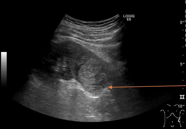 Renal Cell Carcinoma Ultrasound Images
