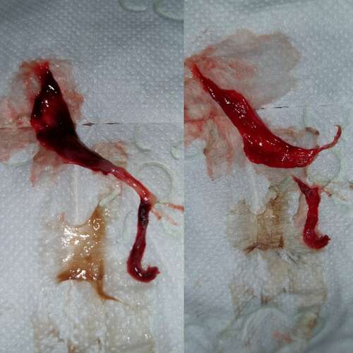 Vroege Miskraam Symptomen