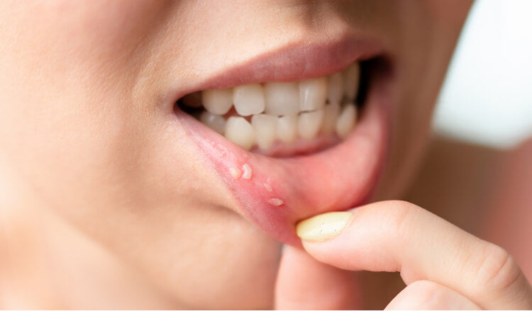 Blaasjes Op Lip Geen Koortslip