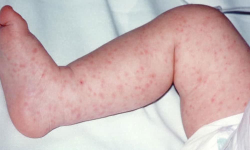 Hersenvliesontsteking Kind