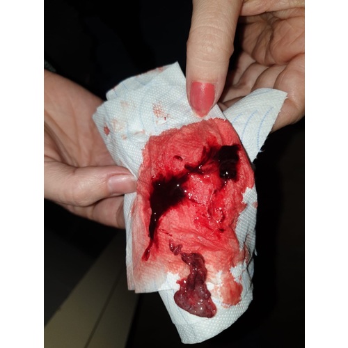 Hoe Ziet Een Miskraam Eruit 2 Weken