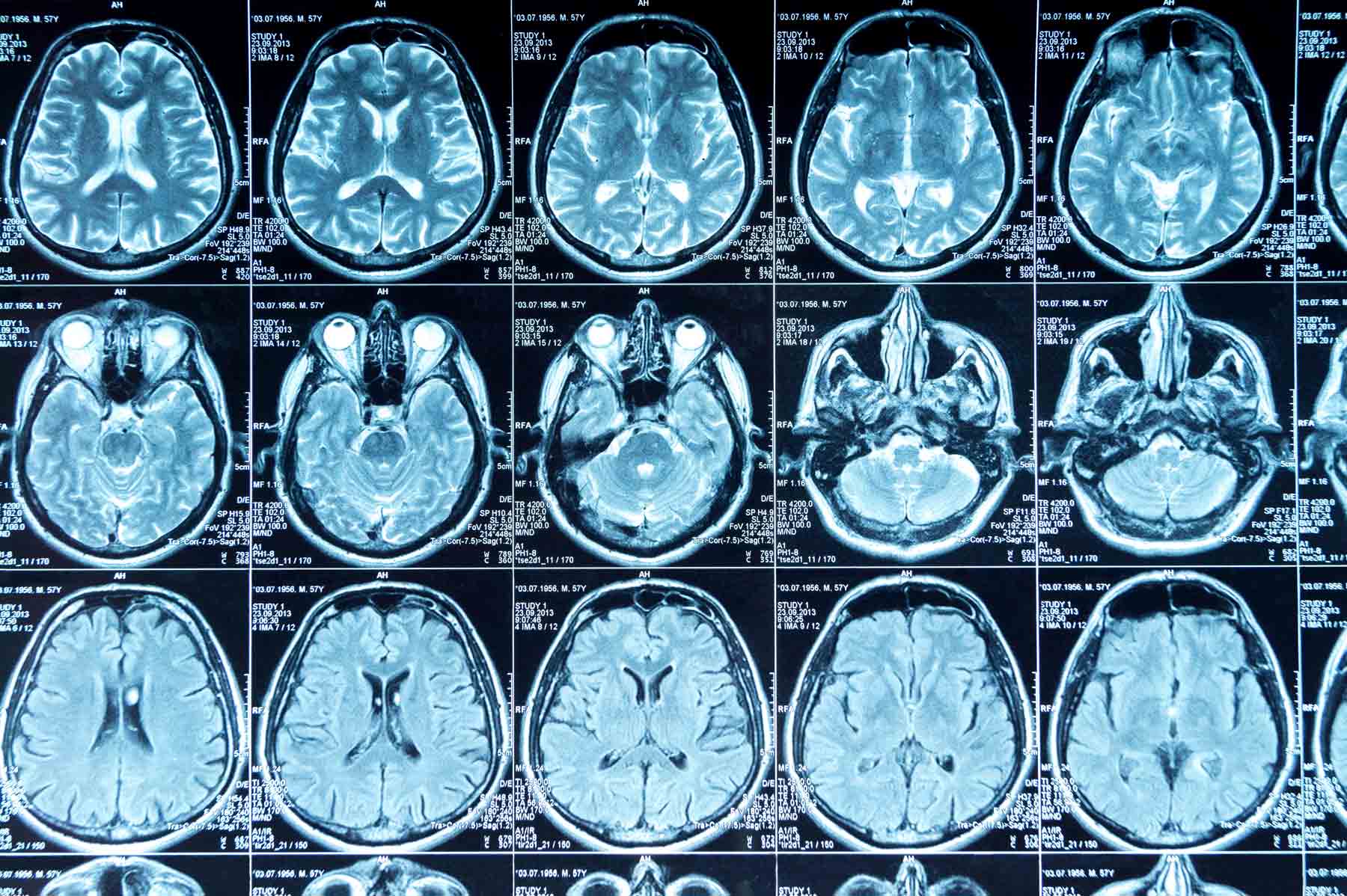 Mri Scan Brain Cost Near Aurora, Co