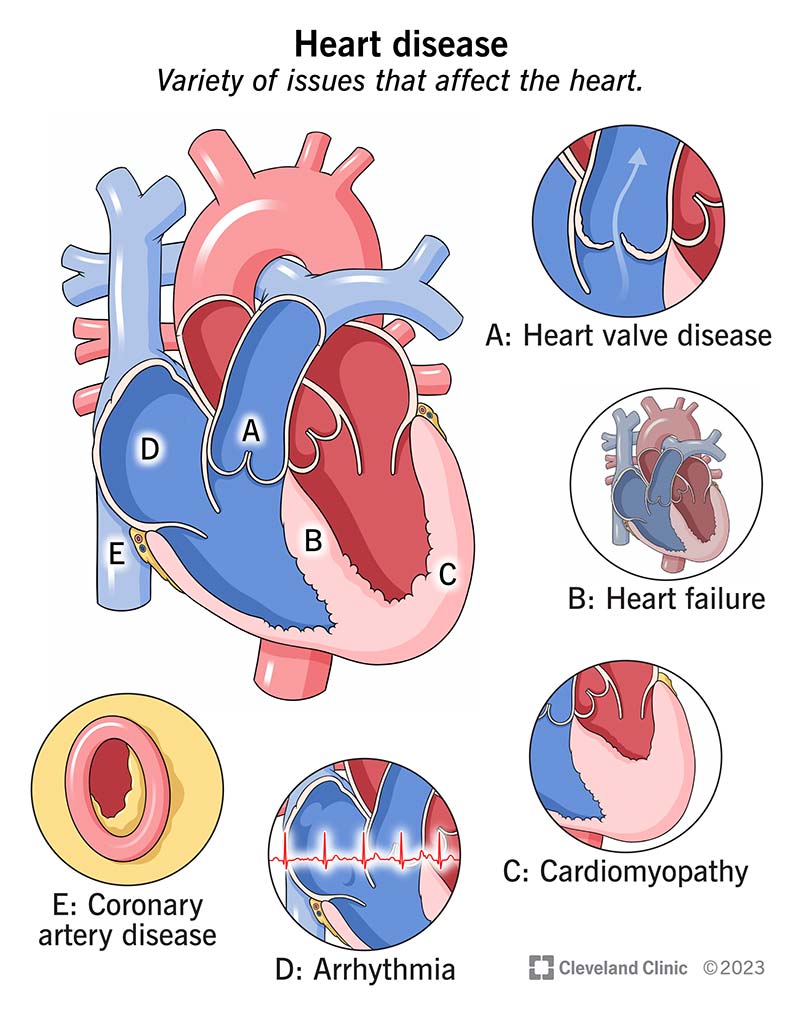 Understanding DI Heart Failure: Symptoms, Stages & Care