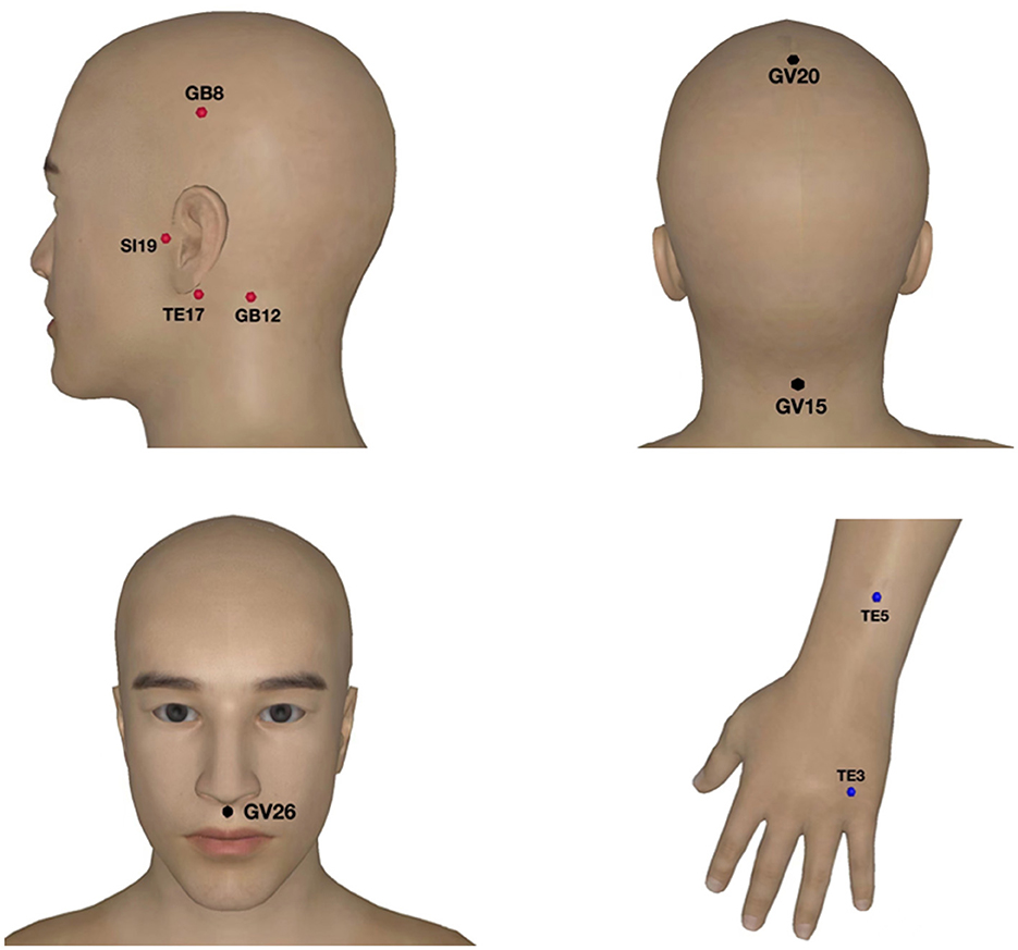 Acupuncture for Tinnitus: Benefits, Risks, and How to Find Help