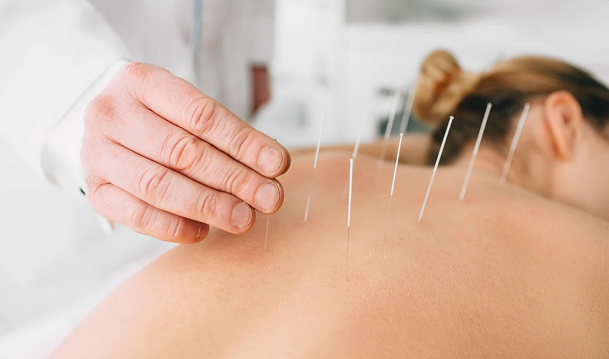 Acupuncture Near Me: Find a Trusted Practitioner Fast