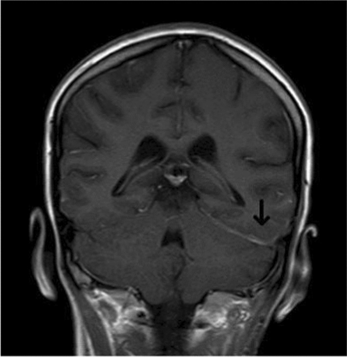 Acute Myeloid Leukemia CNS: What You Need to Know