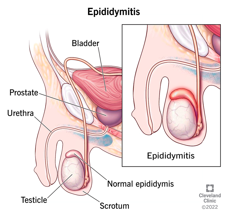 Acute Testicular Pain: Causes, Relief & When to Seek Help
