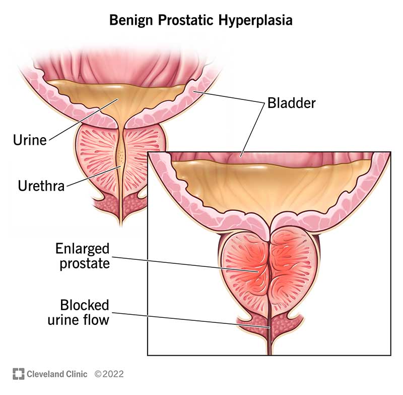 Benign Prostatic Hyperplasia: Symptoms, Causes & Care